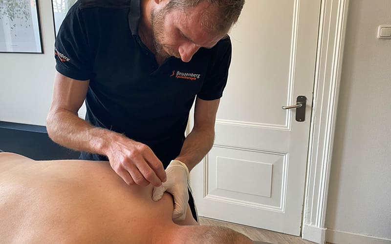 Dry needling behandeling in Groningen bij Fysiotherapie Beuzenberg